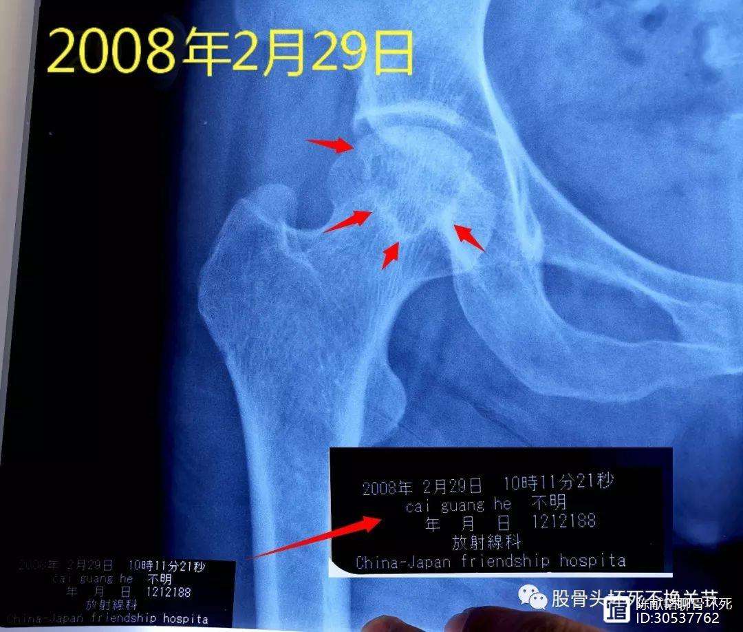 包头人工骨头医保报销多少(人工骨头医保报销多少比例)